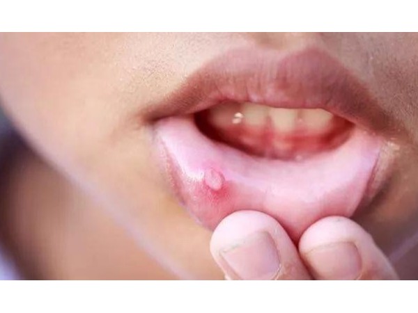 口腔潰瘍吃維C有用嗎？