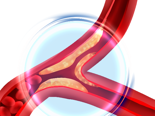 血管堵塞最致命：補(bǔ)硒有利于血管健康
