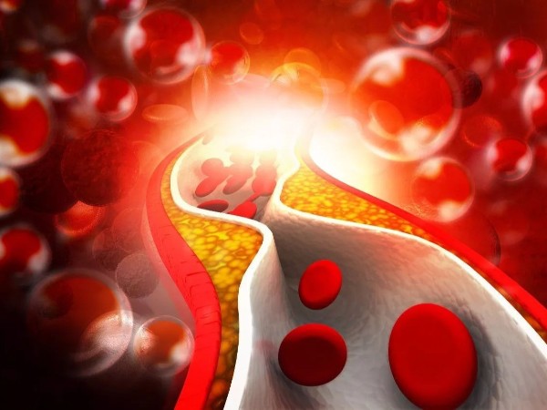 冬天心腦血管頻發，一定要避免血管堵塞