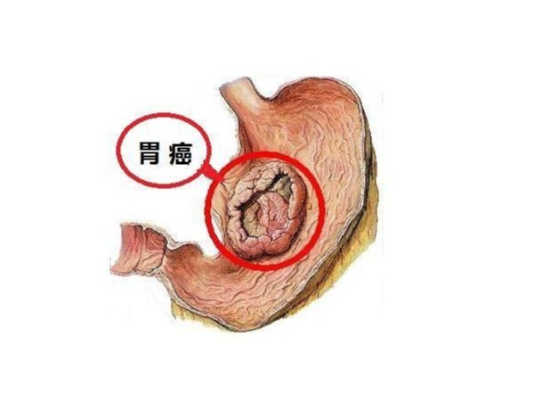 硒元素和胃癌之間的秘密關(guān)系